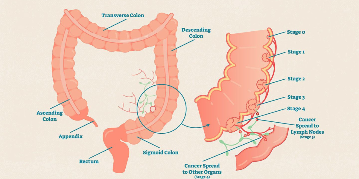 Understanding Colon/Colorectal Cancer: Types And Stages