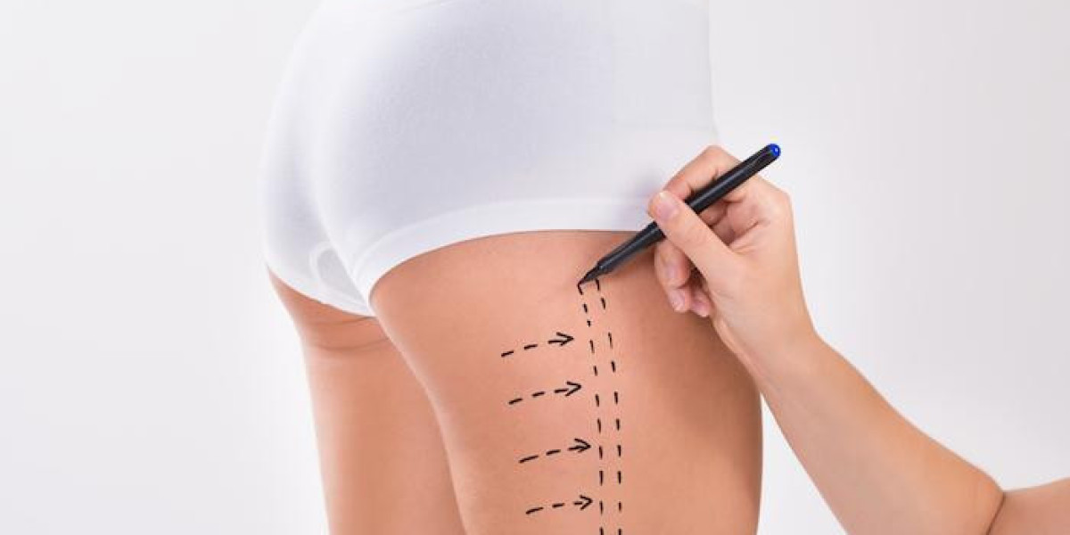 Liposuction for Body Contouring After Significant Weight Loss