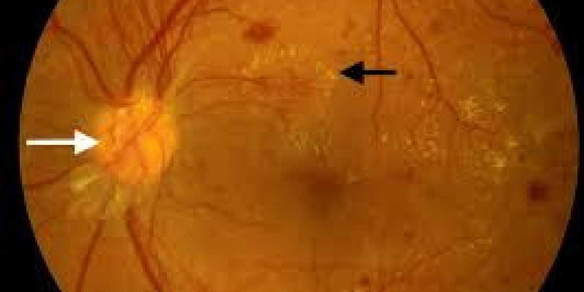 Effective Diabetic Retinopathy Treatments Available in Noida
