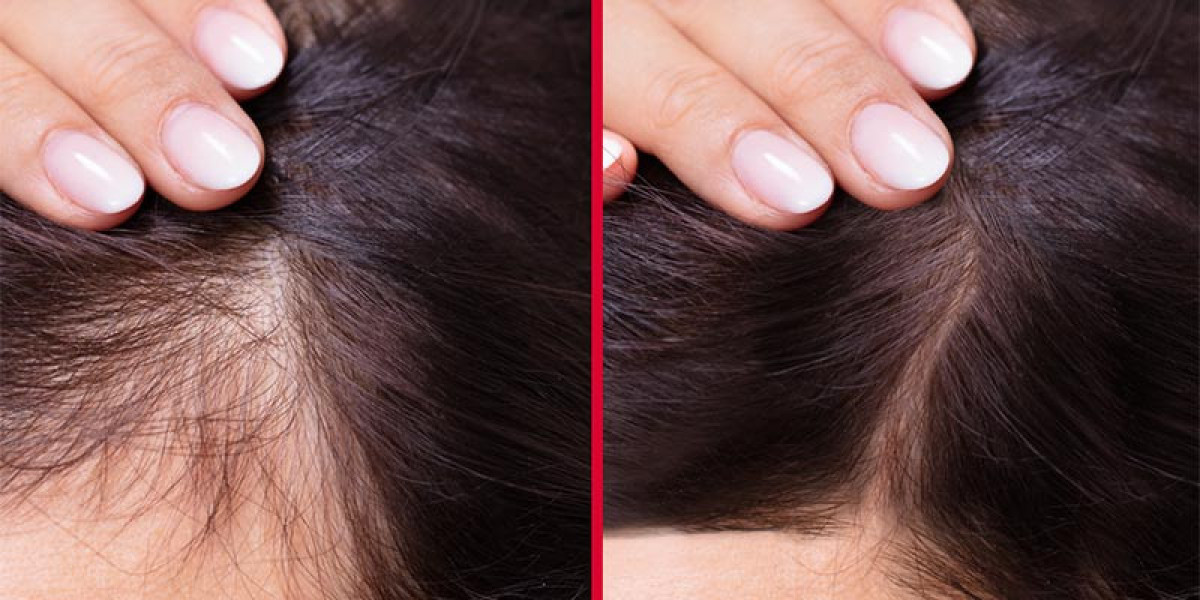 Unlock the Secret to Hair Growth: Comprehensive Guide on Hair Serums for Hair Loss